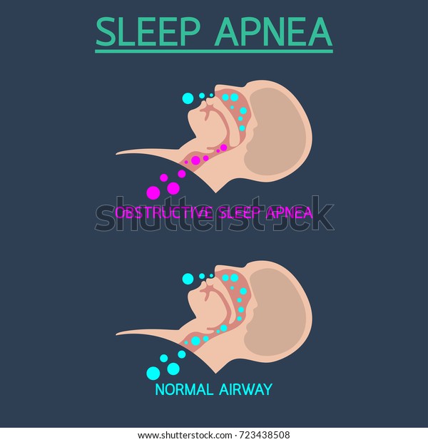 Sleep Apnea vector icon\
illustration