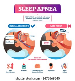 Sleep apnea vector illustration. Labeled nasal tongue blocked airway scheme. Diagram with normal and abnormal breathing comparison. Respiratory problem symptoms with list of untreated diagnosis risks.