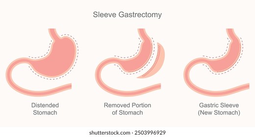 Sleeve gastrectomy, part of the stomach is separated and removed from the body.The remaining section of the stomach is formed into as tubelike structure.This smaller stomach cannot hold as much food.