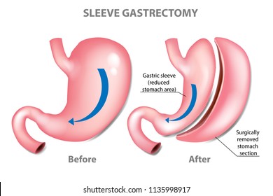 SLEEVE GASTRECTOMY. WEIGHT LOSS SURGERY - before and after