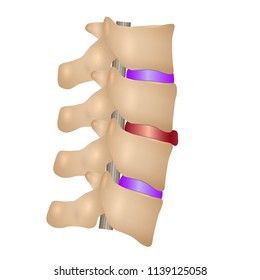 Sliding Out The Disks In The Spine