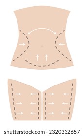 Slim fit woman body with surgical dotted lines before plastic surgery with underwear, arrows, marks on skin.
Concept Fat loss, liposuction, cellulite removal, skin lifting
Editable vector illustration