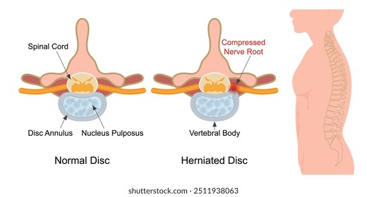 A slipped disc occurs when the outer covering of the disc tears and the internal gel filling (nucleus pulposus) gets pushed out of the covering (herniated), causing the gel to press on the nerve root.