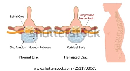 A slipped disc occurs when the outer covering of the disc tears and the internal gel filling (nucleus pulposus) gets pushed out of the covering (herniated), causing the gel to press on the nerve root.