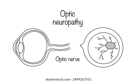 Slow and systematic death of nerve fibers followed by replacement by connective tissue. Drawn eye with optic atrophy. Simple medical illustration with a continuing line.