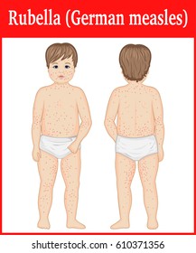 A small child sick rubella shown from two perspectives