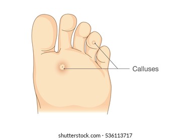 Small circles dead skin on the bottom of soles and toes. Calluses. Illustration about symptoms and pain on foot.