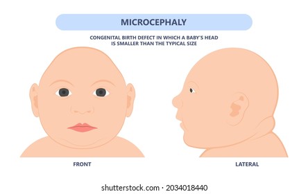 small head zika virus down autism birth defect baby brain infant fetus major severe speech Born gene toxic test genetic disease mutation DNA measure size fetal anoxia drug flat risk svg