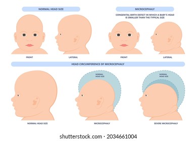 small head zika virus down autism birth defect baby brain infant fetus major severe speech Born gene toxic test genetic disease mutation DNA measure size fetal anoxia drug flat risk svg
