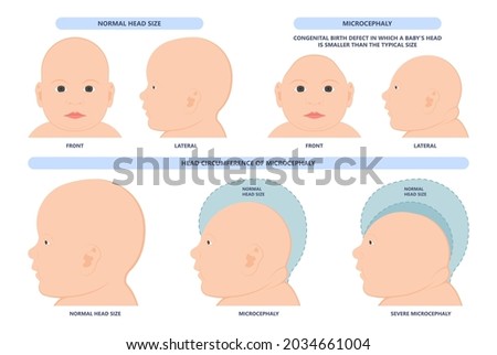 small head zika virus down autism birth defect baby brain infant fetus major severe speech Born gene toxic test genetic disease mutation DNA measure size fetal anoxia drug flat risk