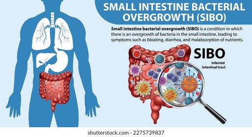 Small Intestine Bacterial Overgrowth (SIBO) illustration