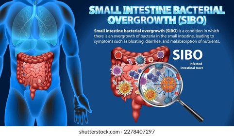 Small Intestine Bacterial Overgrowth (SIBO) illustration