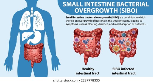 Small Intestine Bacterial Overgrowth (SIBO) illustration