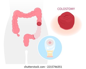 Small and Large Colon blocked Surgery abdomen Pouch with Crohn Hirschsprung disease inflammation of hernia stoma by removal Rectal tract poo stool system Cancer ileum Tumor Loop invasive