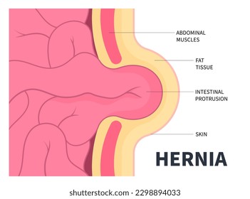 small large intestine constipation umbilical hernia or abdominal pain belly button inguinal incisional Femoral stomach diastasis recti ileus lump navel wall cavity baby infant birth volvulus Hiatus