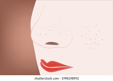 Small pimples and black heads on nose and face