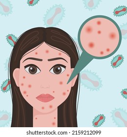 Smallpox virus. Vector illustration of smallpox virus. Monkeypox. Vector illustration of a person affected by smallpox.