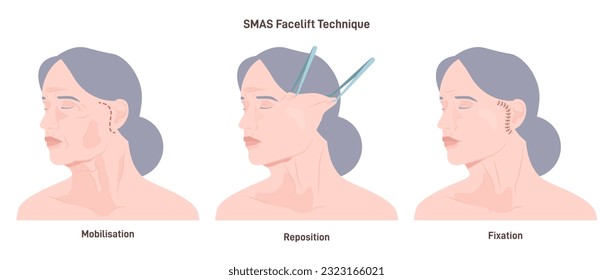 SMAS facelift surgery. Face features correction or anti-aging procedure. Idea of modern face aesthetic medicine. Skin elevation. Flat vector illustration