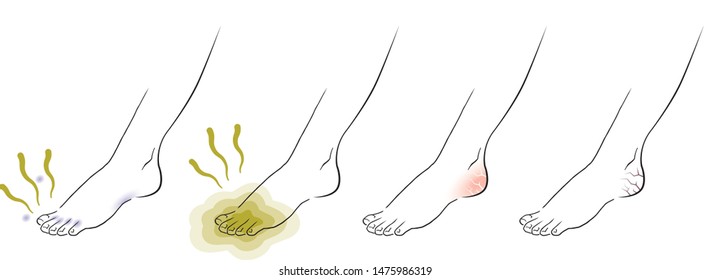 smelly foot and cracked heels