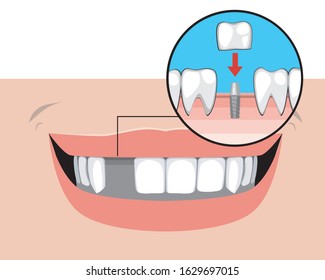 A smile of an adult without a tooth as a concept of implant installation services on a pin. A vector stock illustration with molars and incisors for orthodontic or dental clinic.