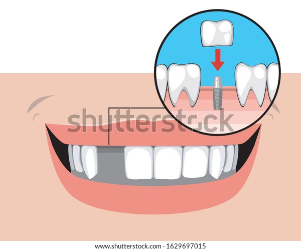 Smile Adult Without Tooth Concept Implant Stock Vector Pin on Your Smile