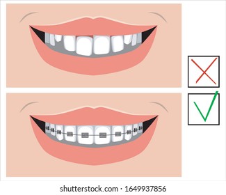 A smile before and after braces for design. Flat vector stock illustration with metal braces on molars and incisors and crooked teeth for a dental or orthodontic clinic