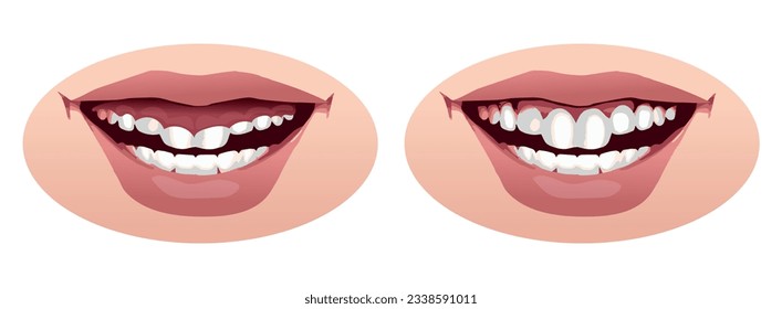 smile before and after gingival plastic surgery procedure, vector illustration.