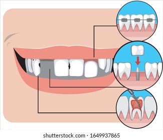 A smile before and after visiting the orthodontist or dentist. Vector stock illustration with oral problems and braces, dental implant and treatment of caries and pulpitis on white background