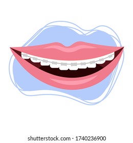 Smile with braces, brekets stock vector illustration isolated on white background. Stomatology, orthodontic, healthcare concept. Dental equipment for correction. White teeth, hygiene.