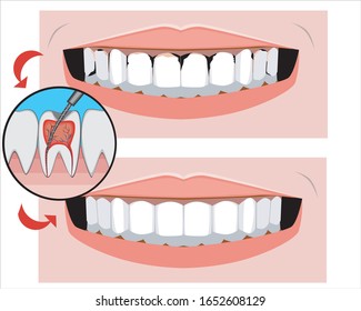 Smile with caries and healthy teeth before and after the dentist. Vector stock illustration as a treatment concept for pulpitis of molars and incisors for design or advertising of orthodontic services