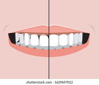 A smile with caris before and after treatment. A flat vector stock illustration with teeth and pulpitis as a concept of problems with molars and incisors for design.