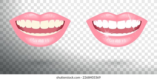 a smile with clean and white teeth and a smile with dirty teeth on a transparent background