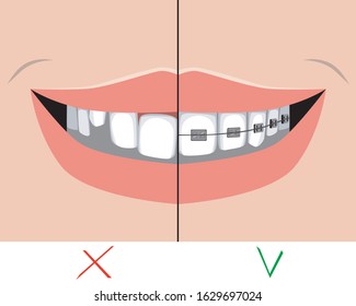 A Smile With Crooked Teeth And Lips Before And After Metal Braces. A Cute Flat Vector Stock Illustration As A Concept Of Orthodontic Or Dental Services.