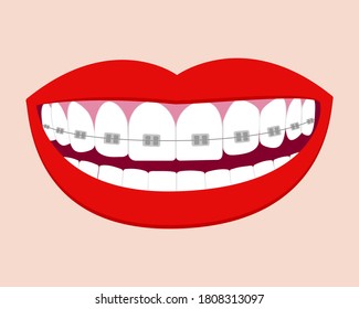 Smile mouth with white teeth in braces. Vector isolated elements. EPS10