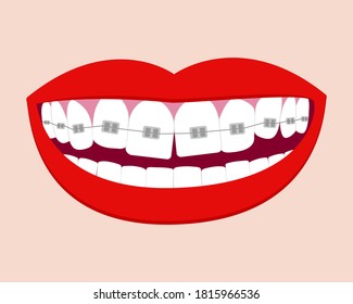 Smile mouth with white teeth in braces. Vector isolated elements. EPS10