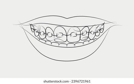 Smile with teeth braces in linear style drawing on white background