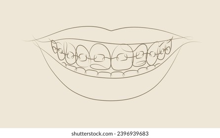 Smile with teeth braces in linear style drawing on beige background