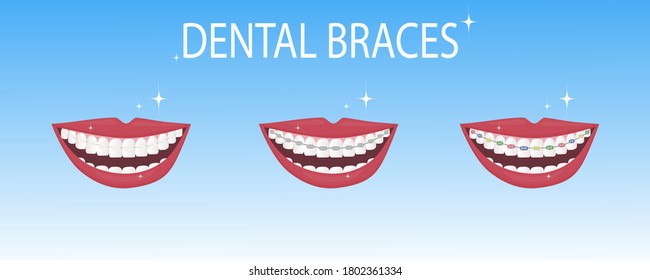 A smile with white and straight teeth with brackets. Dental service - Orthodontic treatment and straightening of teeth. Example of a mouth with different types of braces - metal, ceramic and colored. 