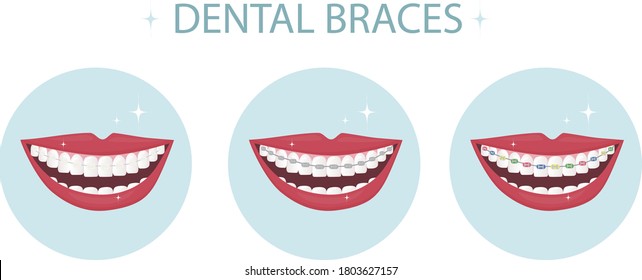 A smile with white and straight teeth with brackets. Dental service - Orthodontic treatment and straightening of teeth. Example of a mouth with different types of braces - metal, ceramic and colored. 