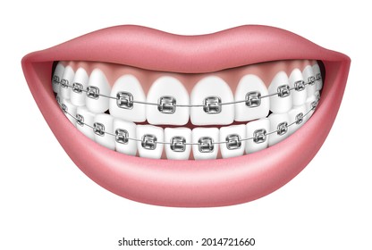 Smile with white teeth and braces. Realistic 3D Vector illustration, isolated on white background,