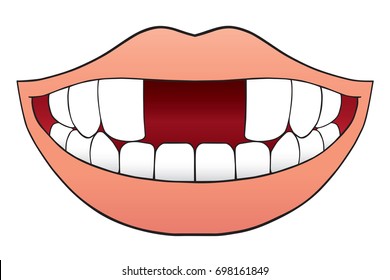 Smiling cartoon mouth with two front teeth missing