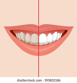 Smiling Mouth with Cleaning Teeth, Before and After Bleaching treatment