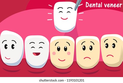 Smiling and upset animated cartoon teeth characters on gum and veneer. Funny teeth dental restoration characters. Putting new veneer on discolored tooth. EPS 10 