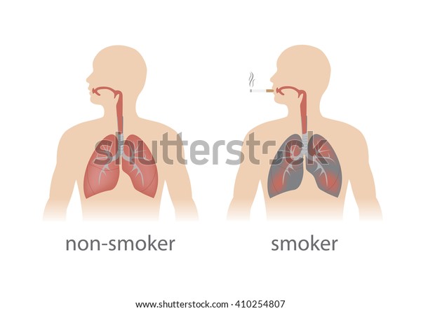 Comparaison Des Poumons Fumeur Et Non Image Vectorielle De Stock Libre De Droits