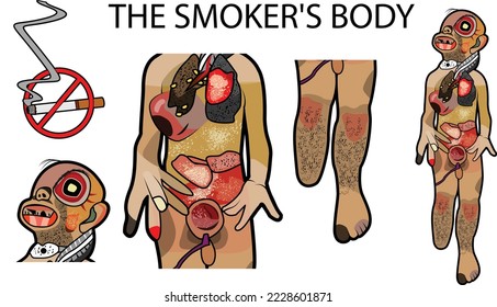 The Smoker's Body,Smoking causes cancer, heart disease, stroke, lung diseases, diabetes, and chronic obstructive pulmonary disease which includes emphysema and chronic bronchitis,Vector illustration.