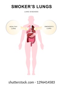 Smokers lung. Danger of smoking