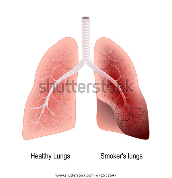 Poumon Du Fumeur Et Poumon Sain Image Vectorielle De Stock Libre De Droits