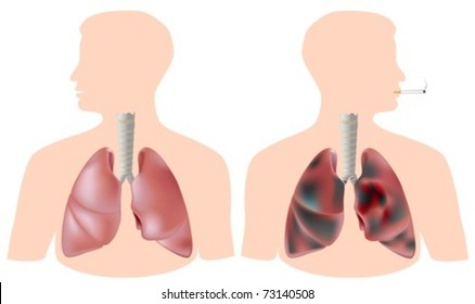 Smoker's lung (with tumor) versus healthy lung