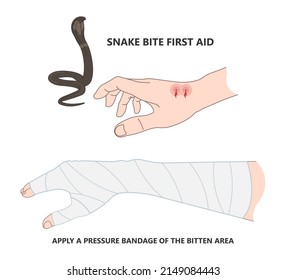 Snake Bite First Aid Poster