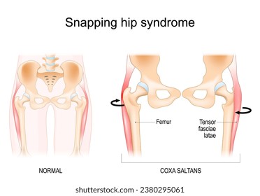 Snapping hip syndrome. Coxa saltans.  iliopsoas tendinitis. dancer's hip. Anatomy of a Human Hip. Vector illustration